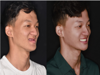 bệnh nhân không răng bẩm sinh và người bị tiêu xương hàm nghiêm trọng bệnh nhân không răng bẩm sinh và người bị tiêu xương hàm nghiêm trọng