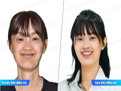 công nghệ định vị cấy ghép implant công nghệ định vị cấy ghép implant
