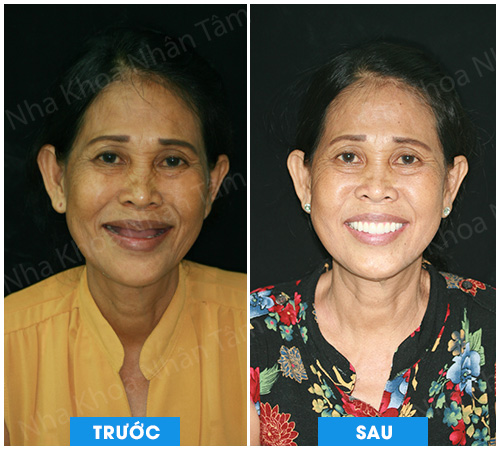 Cấy ghép Implant xương gò má cho bệnh nhân bị tiêu xương hàm trên trầm trọng Cấy ghép Implant xương gò má cho bệnh nhân bị tiêu xương hàm trên trầm trọng
