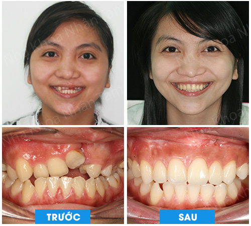 Ghép 2 mảnh xương vỏ mào chậu cho bệnh nhân khe hở môi và vòm miệng Ghép 2 mảnh xương vỏ mào chậu cho bệnh nhân khe hở môi và vòm miệng