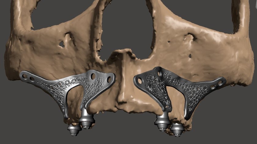 Công nghệ CT Cone Beam 3D giúp thiết kế Implant cá nhân hóa chính xác