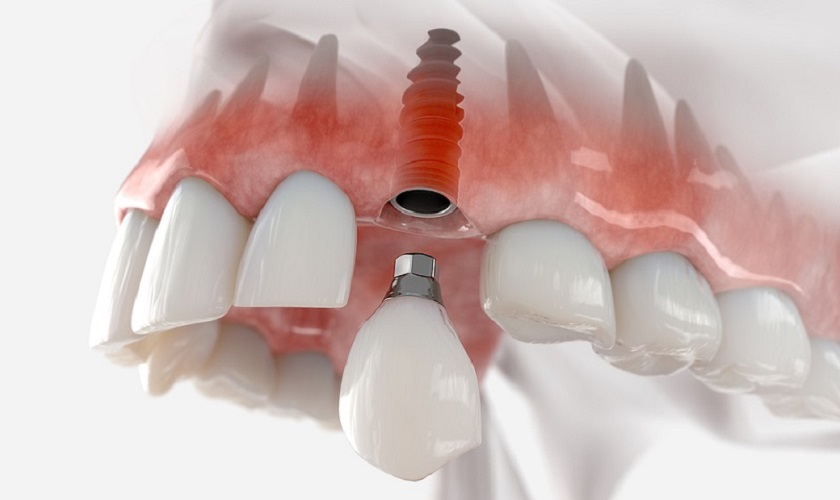 Trồng răng Implant cho người già