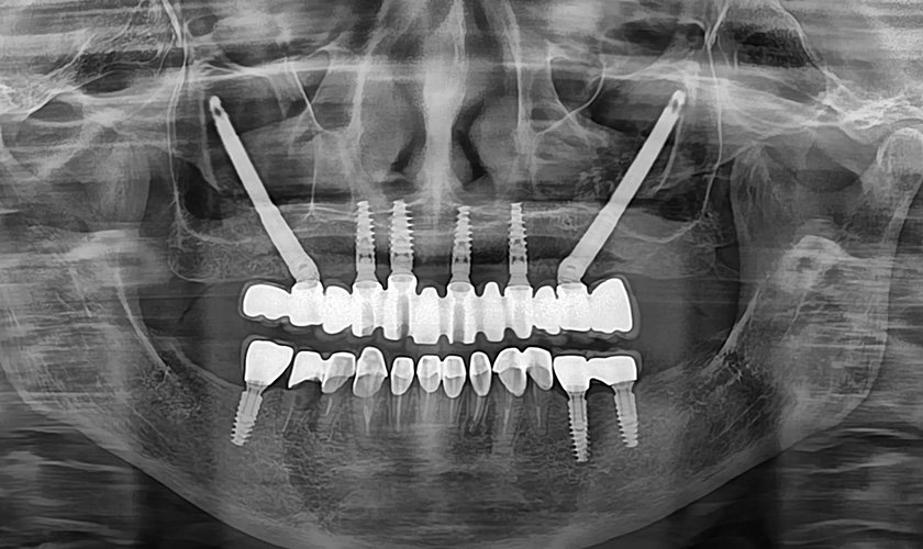 Ảnh chụp X-quang 2 Implant Zygoma ở vùng răng sau và 4 implant thông thường ở vùng răng trước