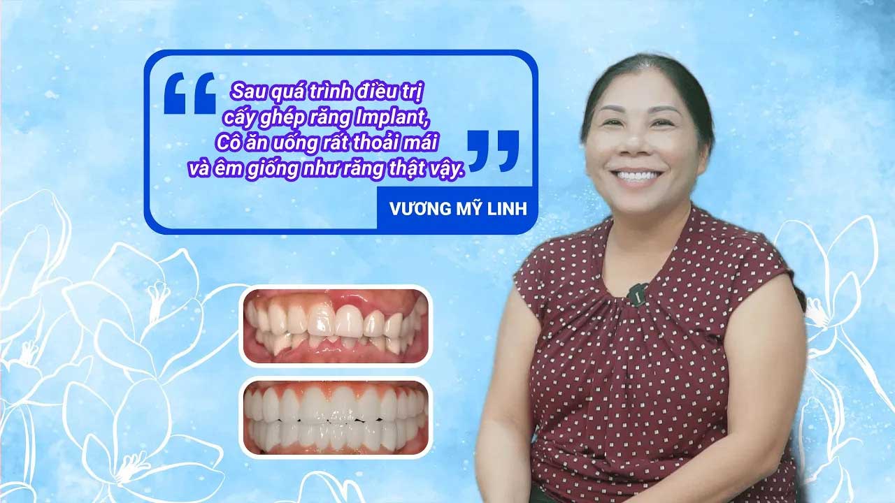 Bay nửa vòng trái đất về Việt Nam trồng răng Implant