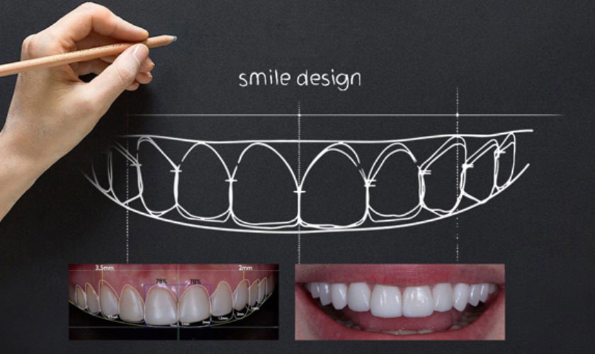 Công nghệ thiết kế nụ cười 2D