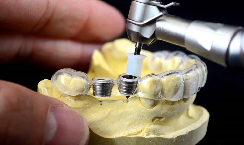 Máng hướng dẫn giúp bác sĩ đặt trụ Implant chính xác