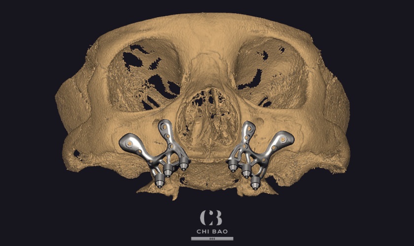 Implant cá nhân hóa có thể áp dụng được trong những trường hợp phức tạp