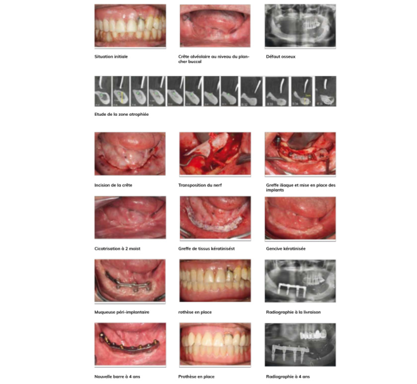 Transposition du nerf alvéolaire inférieur en vue d’une rehabilitation implantaire - Résultats à 4 ans