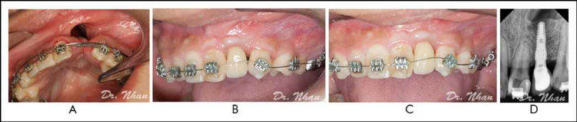 A New Technique in Alveolar Cleft Bone Grafting for Dental Implant Placement 