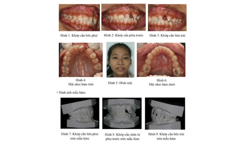 Ứng dụng kỹ thuật mới trên bệnh nhân với tỷ lệ thành công cao