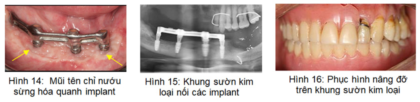 Phẫu thuật dời thần kinh ổ răng dưới và cấy ghép implant