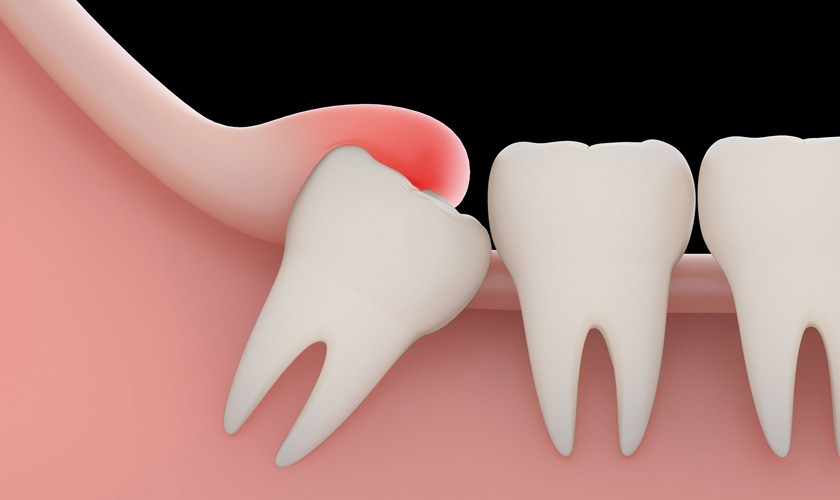 Răng khôn mọc lệch gây đau răng, viêm nướu trùm