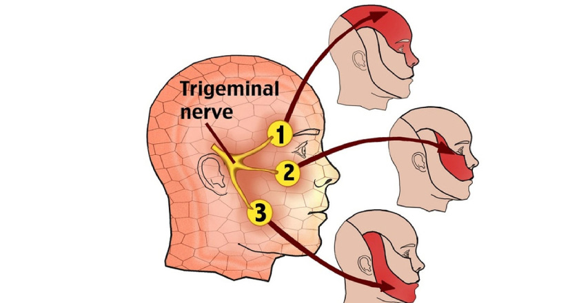 Dây thần kinh V là dây thần kinh lớn nhất vùng sọ mặt