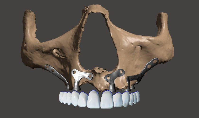 Lựa chọn vật liệu Implant phù hợp