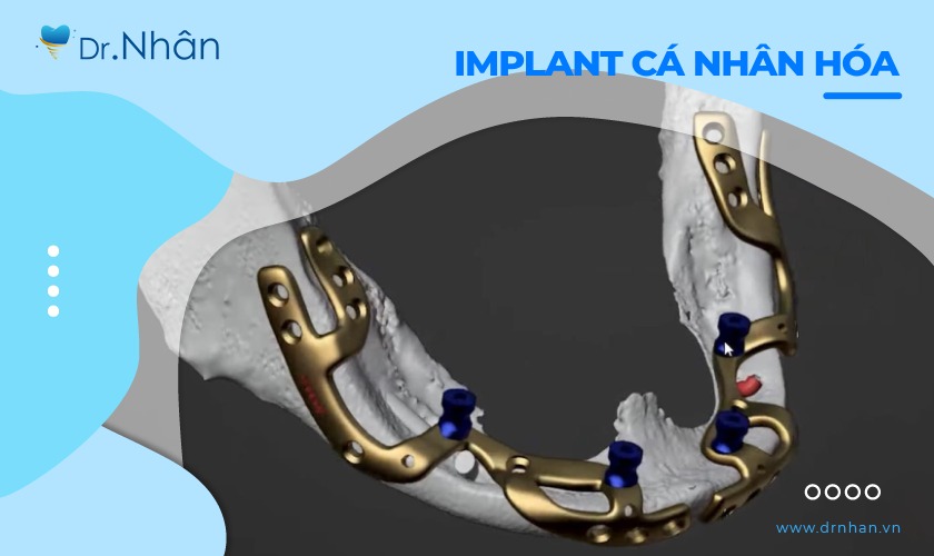 Đánh giá của khách hàng sau khi cấy ghép implant cá nhân hóa