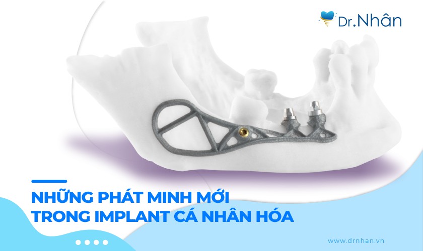 Những phát minh mới trong kỹ thuật Implant cá nhân hóa