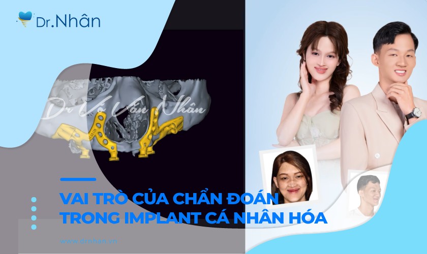 Tầm quan trọng của chẩn đoán chính xác trong implant cá nhân hóa