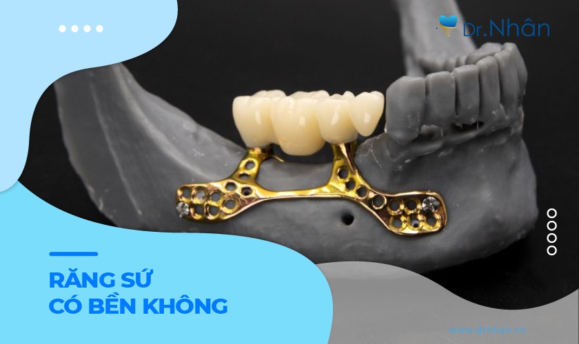 Những yếu tố ảnh hưởng đến tuổi thọ của implant cá nhân hóa