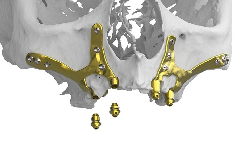 Implant cá nhân hóa được thiết kế dựa trên cấu trúc xương hàm của khách hàng