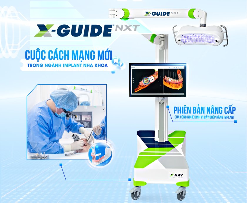 Công nghệ định vị X-Guide mang lại rất nhiều lợi ích trong cấy ghép Implant cá nhân hóa