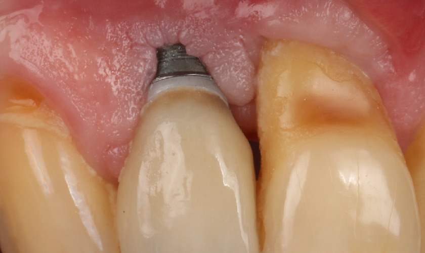 Quá trình cấy ghép Implant không đúng tiêu chuẩn có thể gây ra biến chứng Quá trình cấy ghép Implant không đúng tiêu chuẩn có thể gây ra biến chứng