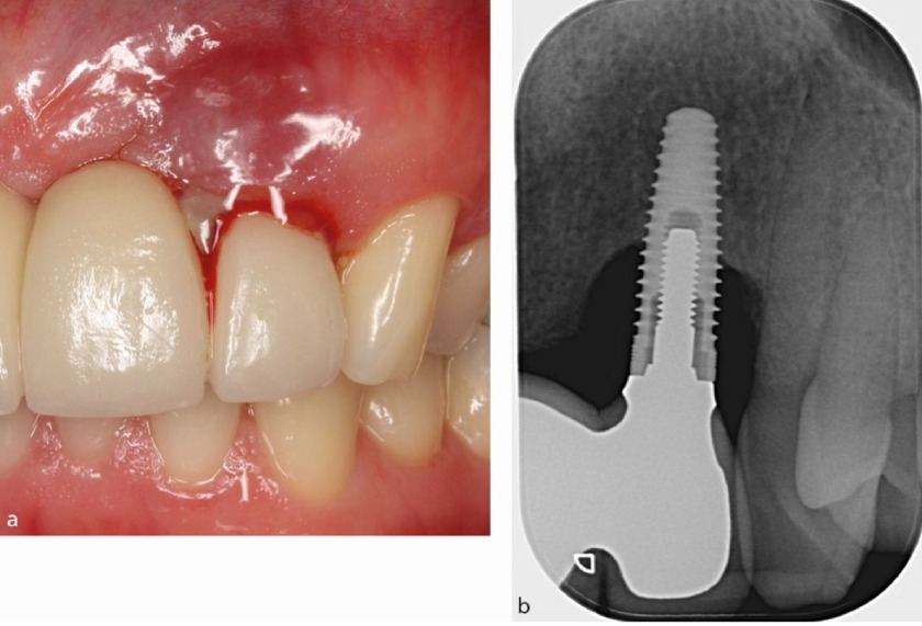 Viêm quanh Implant là biến chứng khá nguy hiểm Viêm quanh Implant là biến chứng khá nguy hiểm