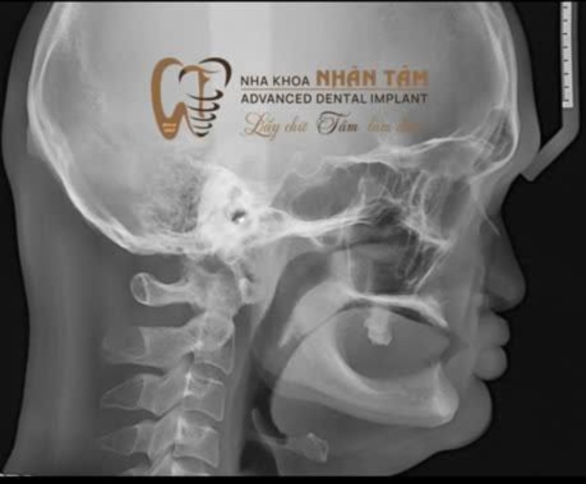 Hình ảnh X-quang của trường hợp không răng bẩm sinh Hình ảnh X-quang của trường hợp không răng bẩm sinh