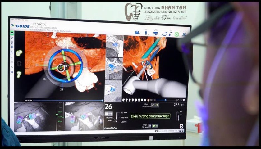 Cần kết hợp giữa kinh nghiệm của bác sĩ và công nghệ hiện đại để mang đến sự thành công cho ca phẫu thuật cấy Implant Cần kết hợp giữa kinh nghiệm của bác sĩ và công nghệ hiện đại để mang đến sự thành công cho ca phẫu thuật cấy Implant