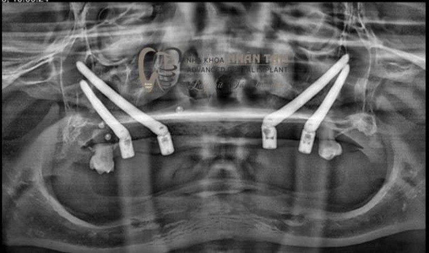 Hình ảnh phim X-quang sau khi cấy ghép Implant Hình ảnh phim X-quang sau khi cấy ghép Implant