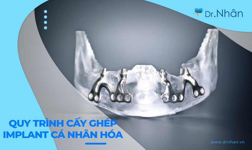 Các tiêu chuẩn quốc tế trong quy trình implant cá nhân hóa