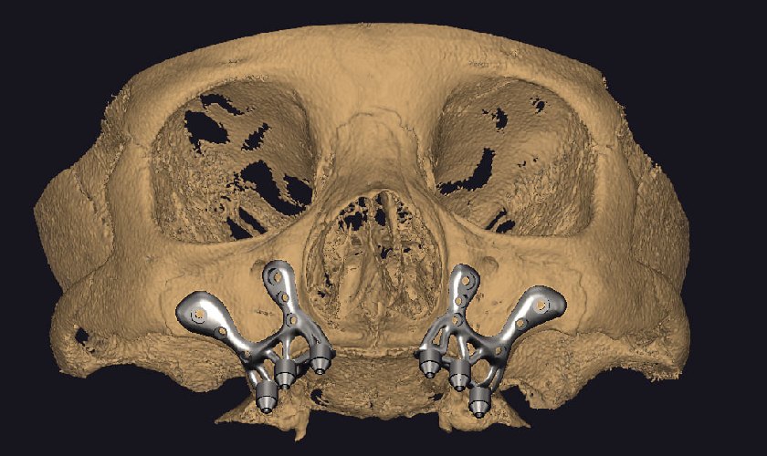 Kỹ thuật cấy ghép implant cá nhân hóa