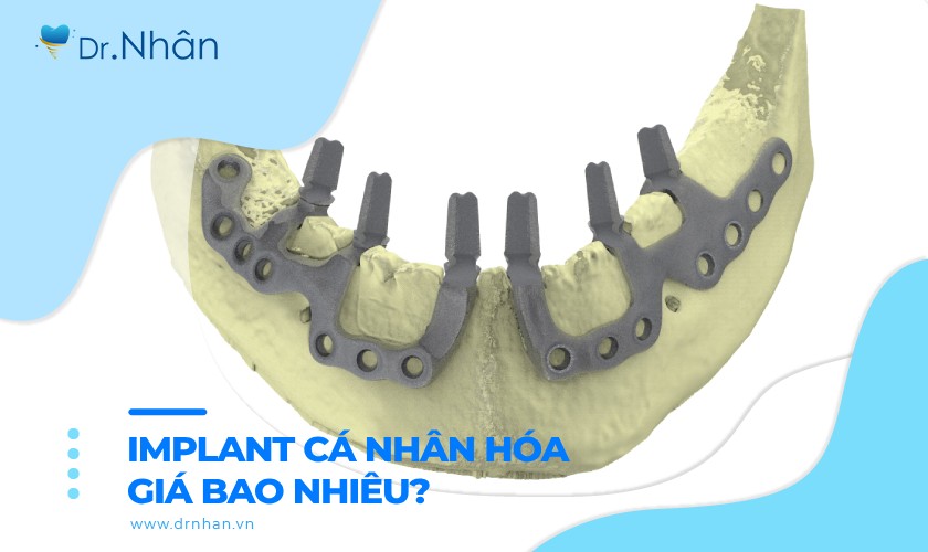 Cấy ghép implant cá nhân hoá giá bao nhiêu?