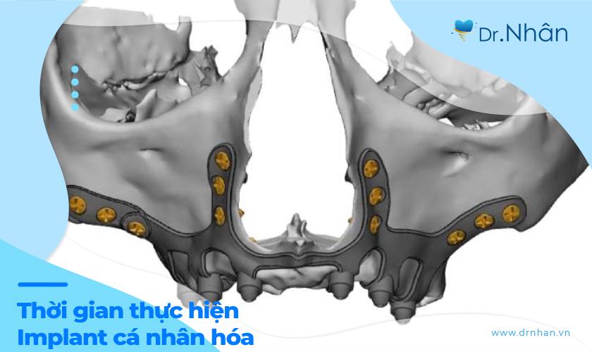 Cấy ghép Implant cá nhân hóa mất bao lâu?