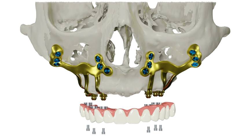 Cấy ghép Implant cá nhân hóa hoàn toàn khác biệt với kỹ thuật Implant truyền thống