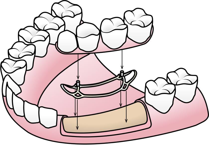 Cấy ghép Implant cá nhân hóa sử dụng bộ cấy ghép đặc biệt đặt tại vị trí dưới màng xương thay vì cấy trụ Implant vào xương hàm như thông thường