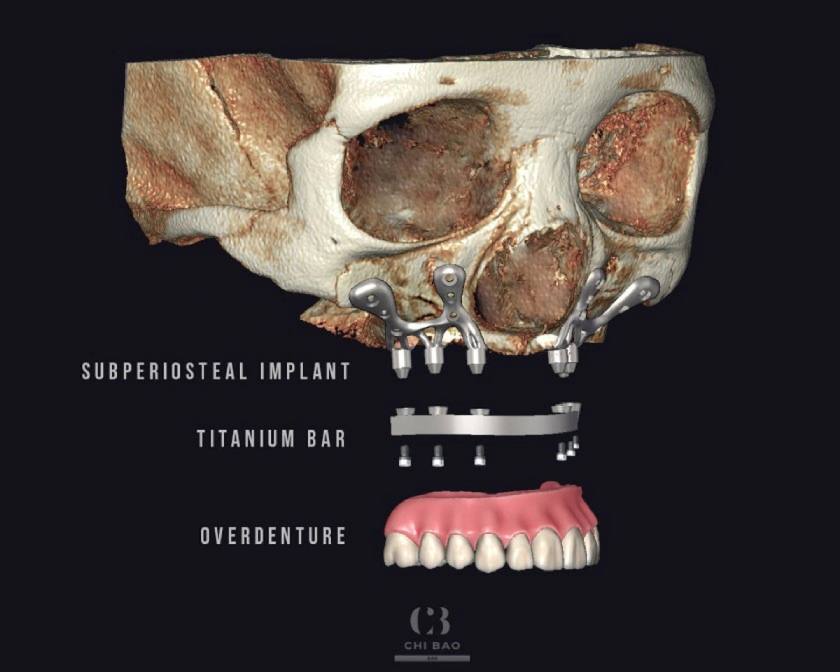 Kỹ thuật Implant cá nhân hóa phù hợp với những bệnh nhân xương hàm bị teo mỏng nghiêm trọng