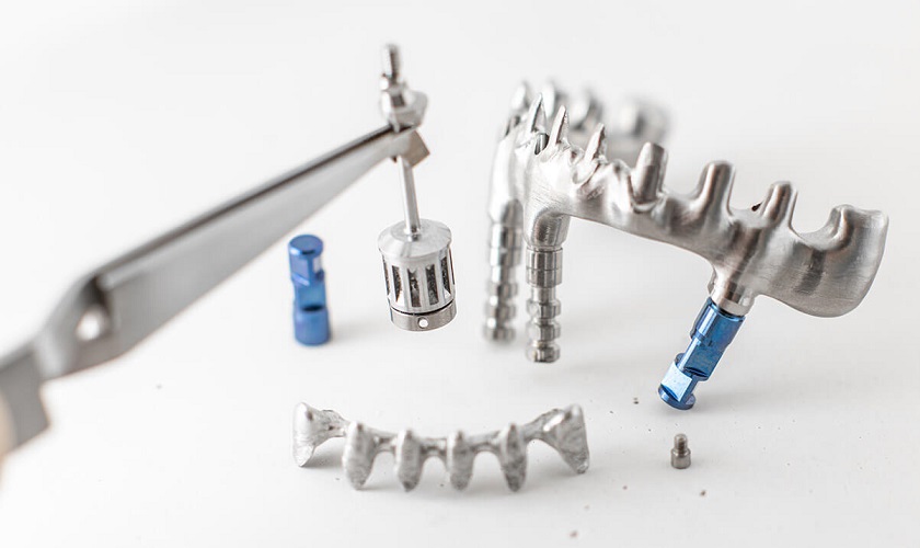 Bộ cấy ghép Implant cá nhân hóa được thiết kế và chế tác bởi các kỹ thuật viên tại nước ngoài