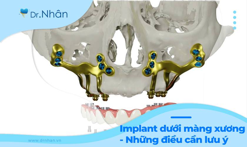 Cấy ghép Implant dưới màng xương cần lưu ý điều gì?