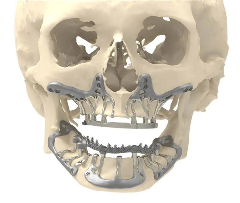 Implant dưới màng xương có độ ổn định vững chắc để nâng đỡ phục hình răng bên trên, giúp bệnh nhân thực hiện tốt chức năng ăn nhai