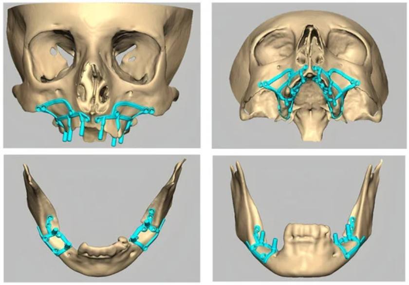 Kỹ thuật cấy ghép Implant dưới màng xương được giới thiệu vào những năm 1940, tuy nhiên do thời điểm đó còn hạn chế về công nghệ, chuyên môn Bác sĩ nên tỷ lệ thành công chỉ khoảng 30-40 %