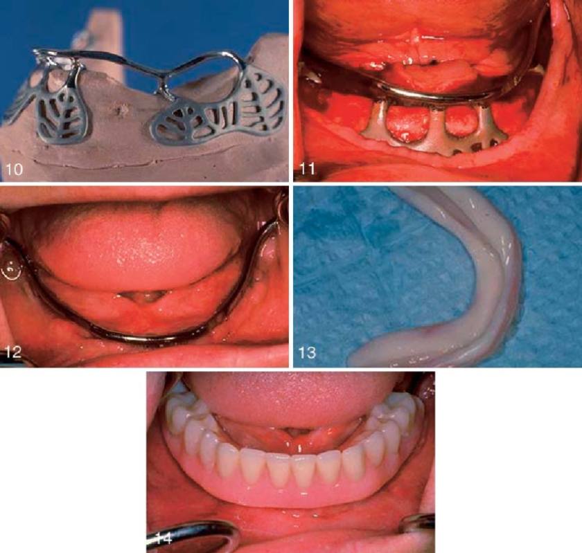 Bộ cấy ghép Implant dưới màng xương mang tính cá nhân hóa do được thiết kế và chế tác riêng biệt cho từng bệnh nhân