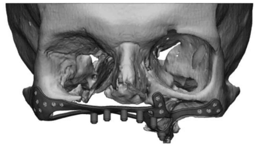 Cấy ghép Implant cá nhân hóa vẫn tồn tại nhiều thách thức, do đó, đòi hỏi cao về tay nghề của Bác sĩ cũng như trang thiết bị - công nghệ