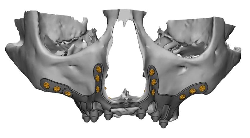 Bộ cấy ghép Implant dưới màng xương được gửi cho các kỹ thuật viên ở nước ngoài thiết kế và chế tác, do đó cần sự phối hợp chặt chẽ giữa Bác sĩ và kỹ thuật viên để đảm bảo bộ cấy ghép được chế tác chính xác