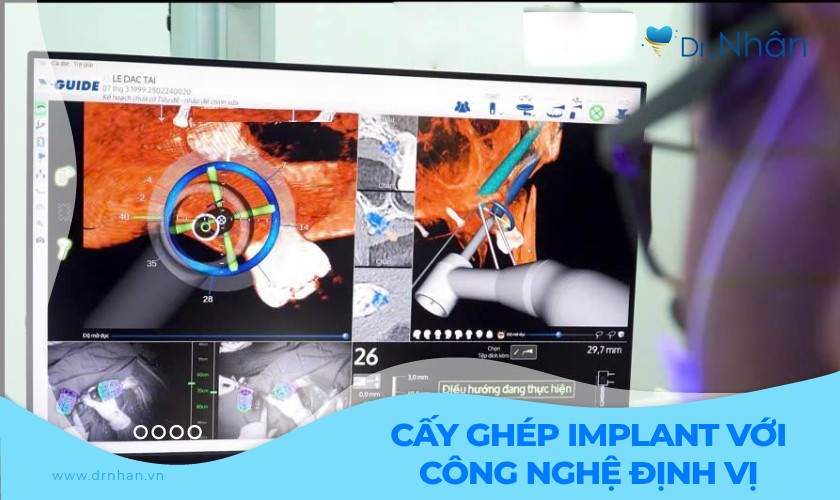 Cấy ghép Implant với công nghệ định vị: Bước tiến mới trong nha khoa hiện đại