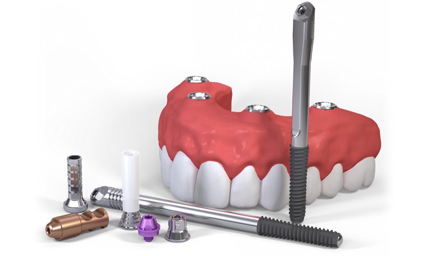 Implant xương gò má giúp phục hình răng hoàn hảo