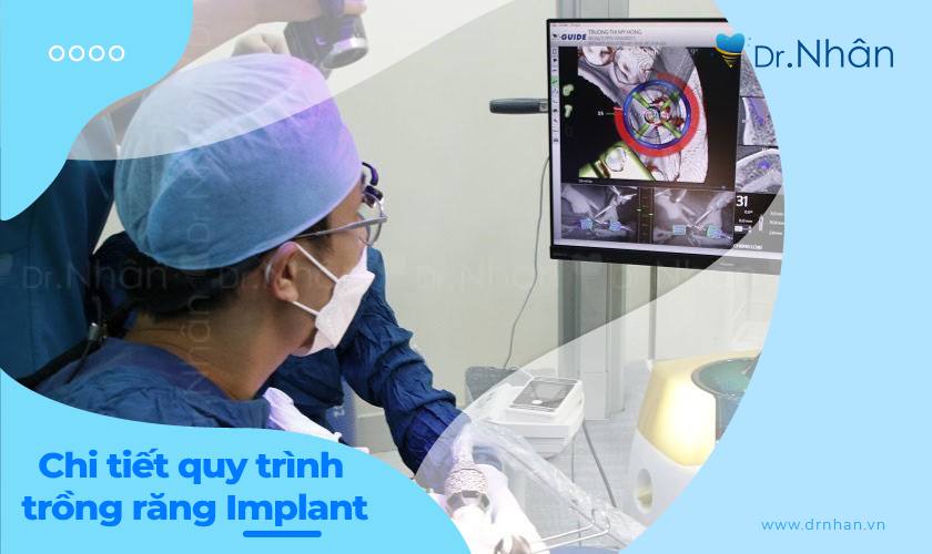 Chi tiết quy trình trồng răng Implant chuẩn y khoa Chi tiết quy trình trồng răng Implant chuẩn y khoa