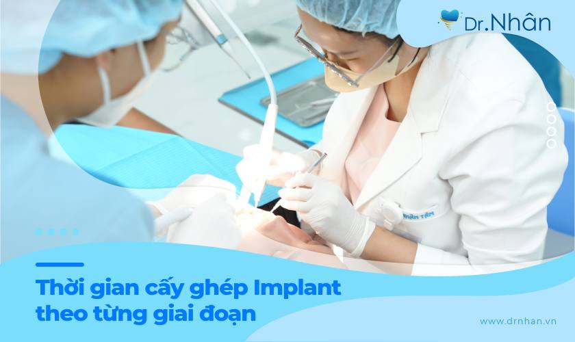 Chi tiết thời gian cấy ghép Implant theo các giai đoạn Chi tiết thời gian cấy ghép Implant theo các giai đoạn