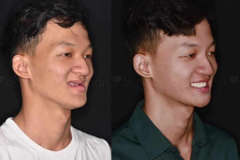 Phục hình răng cho chàng trai không răng bẩm sinh bằng kỹ thuật Implant Phục hình răng cho chàng trai không răng bẩm sinh bằng kỹ thuật Implant