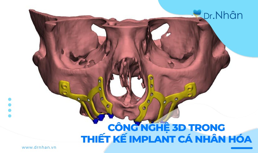 Công nghệ 3D trong thiết kế implant cá nhân hóa