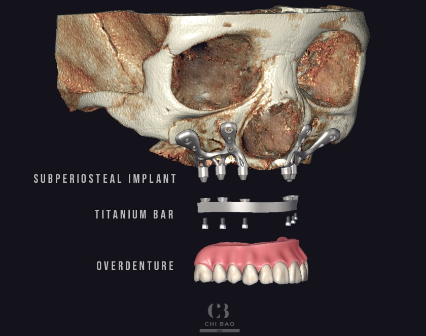 Cấu tạo của implant cá nhân hóa